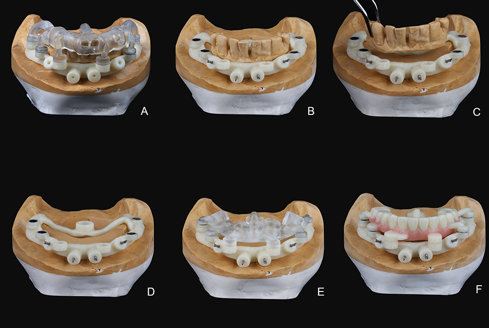 Stages of dental implant surgical guide design and prosthesis fitting